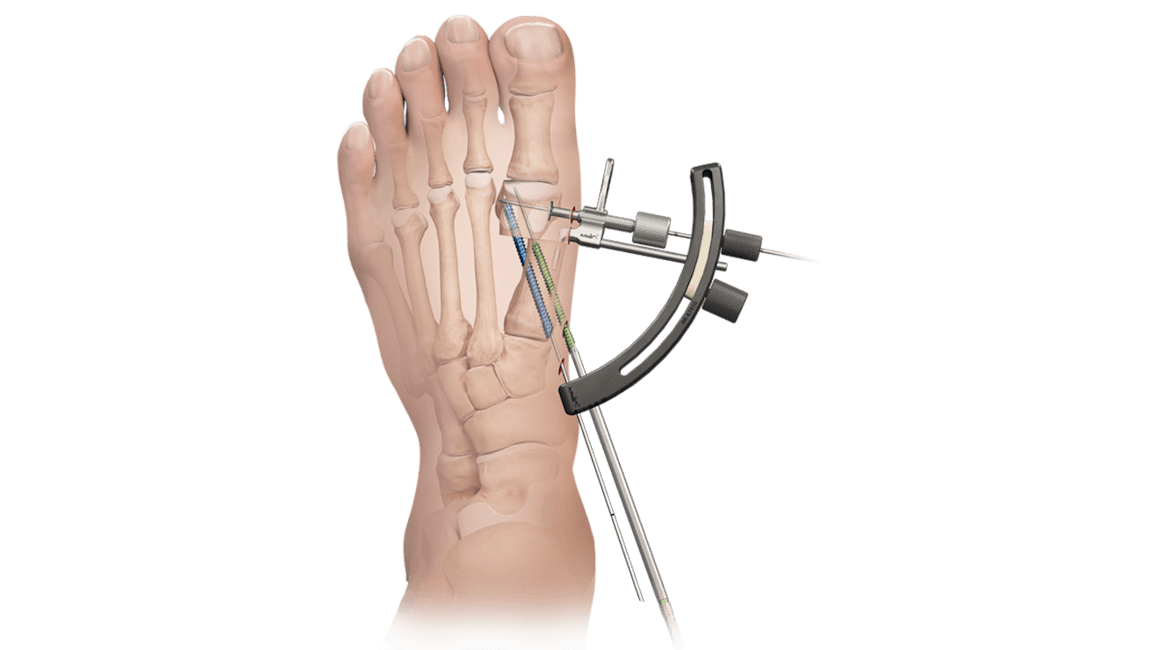 Arthrex - Foot and Ankle